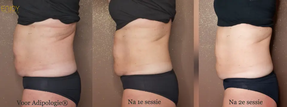 Resultaat vóór Adipologie®, na de 1e en na de 2e sessie